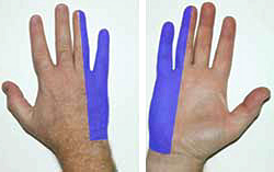 Ulnar Nerve Entrapment at the Elbow (Cubital Tunnel Syndrome ...