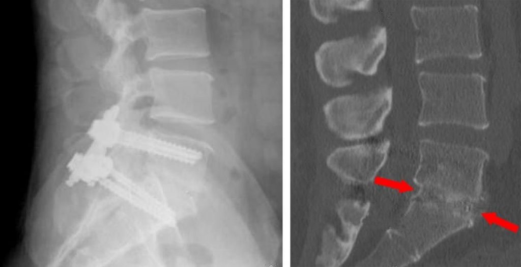 SPINAL FUSION: Minimally Invasive, TLIF and PLIF - Dr Prem Pillay